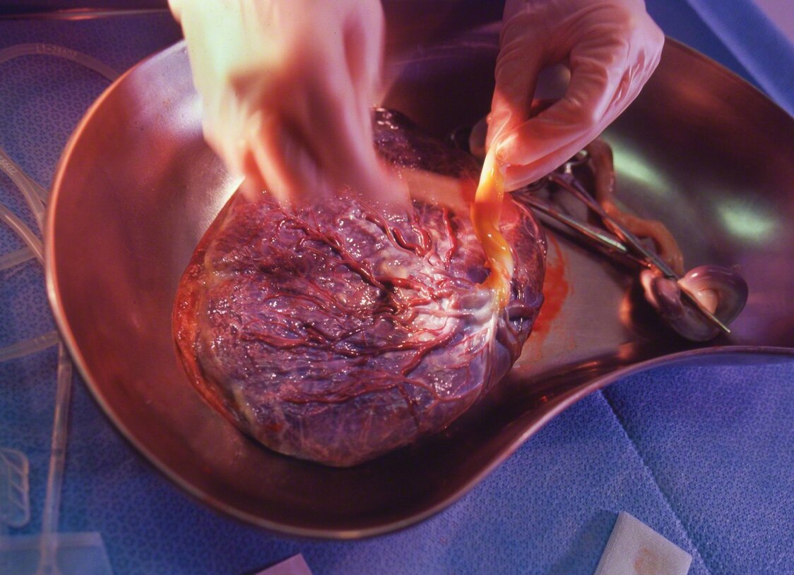 The cord blood that remains inside the umbilical cord and placenta is rich in blood-forming stem cells, and has many uses in regenerative medicine. (© Ōnishi Naruaki)