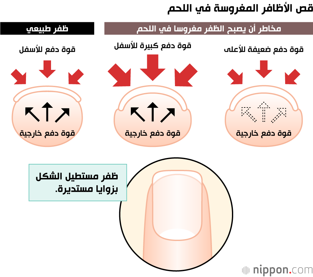 قص الأظافر المغروسة في اللحم