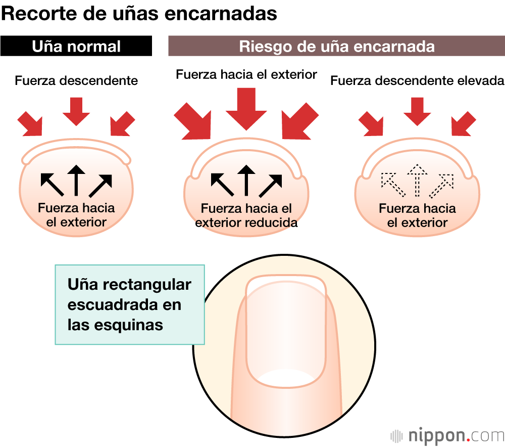 Recorte de uñas encarnadas