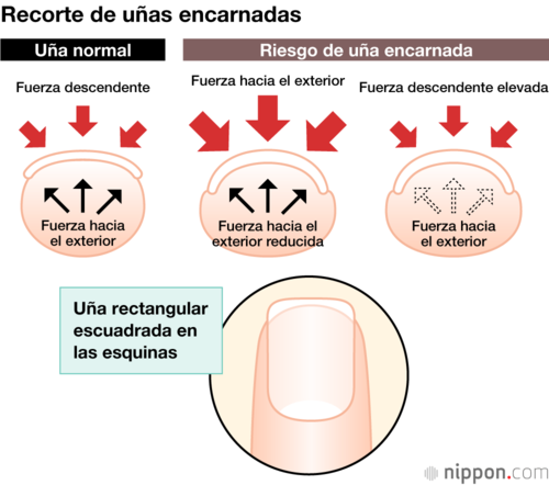 Recorte de uñas encarnadas