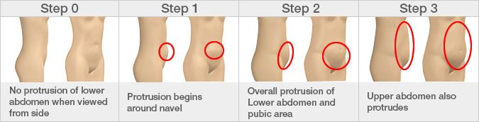 Changes in hip shape over time: The age at which this change begins varies greatly, with some women in their forties still at Step 0.