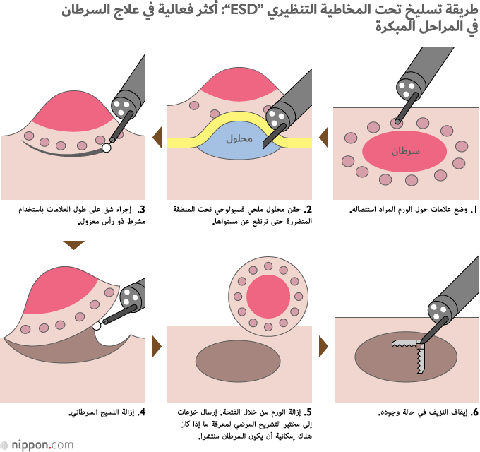 تعد طريقة تسليخ تحت المخاطية التنظيري ’’ESD‘‘ أحدث الطرق الجراحية التي تتم بالتنظير الداخلي. في السابق، كانت إجراءات استئصال المخاطية بالتنظير ’’EMR‘‘ تستخدم أداة على شكل سلك فيه عروة  لاستئصال الأورام، ولكنها كانت مناسبة فقط للنموات الورمية التي تكون دون حجم معين. ولكن باستخدام طريقة ’’ESD‘‘ يستطيع الأطباء بمشرط صغير استئصال الأورام ذات القطر الأكبر من 2 سم. وفي اليابان، خضع ربع مرضى سرطان المعدة بالفعل لمثل هذه المعالجة. المصدر: ’’غان نو كيرازو ني ناؤسو نايشيكيو تشيريو ESD غا واكارو هون (معرفة ESD: إجراء لعلاج السرطان بدون جراحة كبرى)‘‘، دار النشر كودانشا لعام 2011.