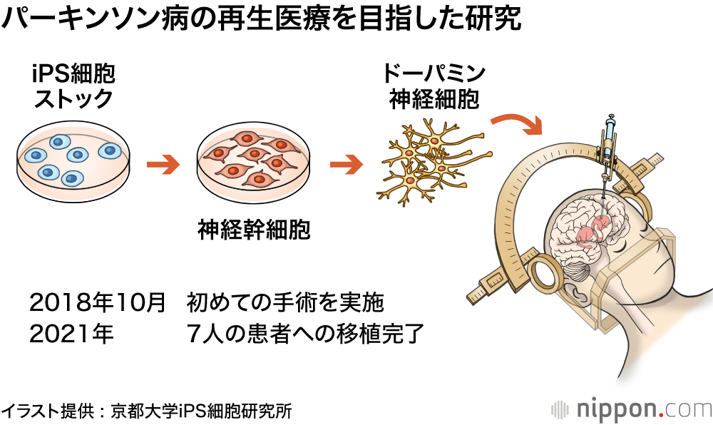 パーキンソン病の再生医療を目指した研究