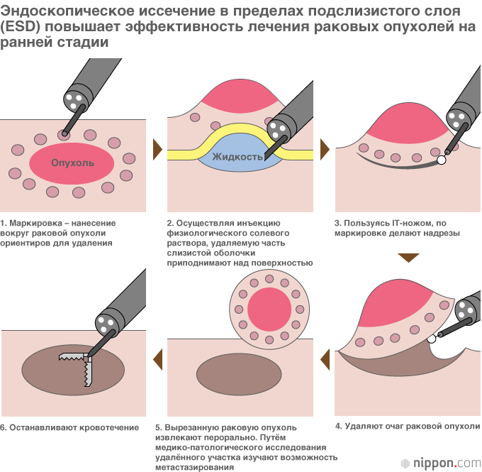 ESD (эндоскопическое иссечение в пределах подслизистого слоя) – новейший метод операций, выполняемый с помощью эндоскопа. Прежде при проведении операций EMR (эндоскопическая резекция слизистой) раковую опухоль вырезали, захватывая её устройством наподобие лассо, что ограничивало размер опухоли, которую возможно было удалить таким образом. При операциях ESD использование режущей рабочей насадки эндоскопа позволяет удалять опухоли величиной более 2 см. В Японии уже сейчас операции методом ESD проводятся каждому четвертому пациенту с раком желудка. Источник: «Книга сведений об ESD – эндоскопическом лечении рака без хирургического вмешательства», изд-во «Коданся»