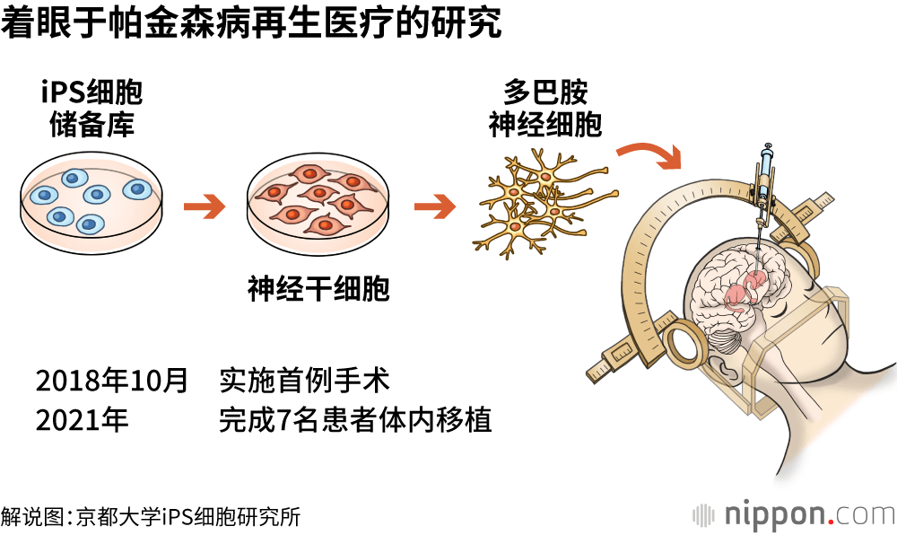 着眼于帕金森病再生医疗的研究