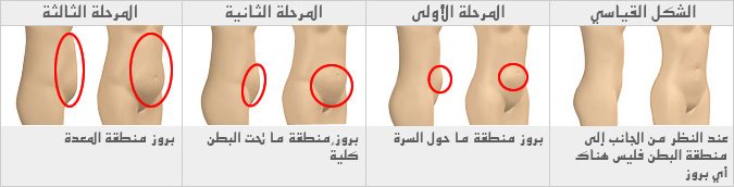 [تغير شكل الأرداف مع التقدم في العمر] ويختلف السن الذي نبدأ فيه هذه التغييرات حسب النساء، فمثلاً هناك نساء لا يبدأ ارتخاء أردافهن حتى عند بلوغ الأربعينات.