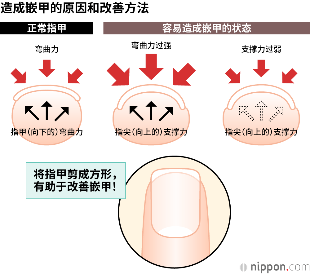 造成嵌甲的原因和改善方法