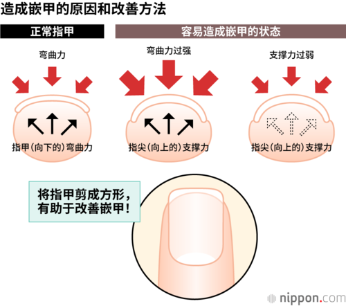 造成嵌甲的原因和改善方法
