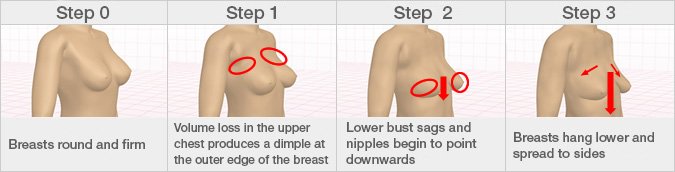 Changes in bust shape with age: These changes usually start in a woman’s twenties, but some are already at Step 2 by that age.