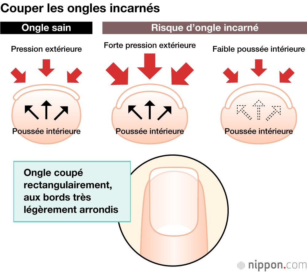 Couper les ongles incarnés