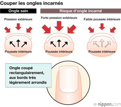 Couper les ongles incarnés