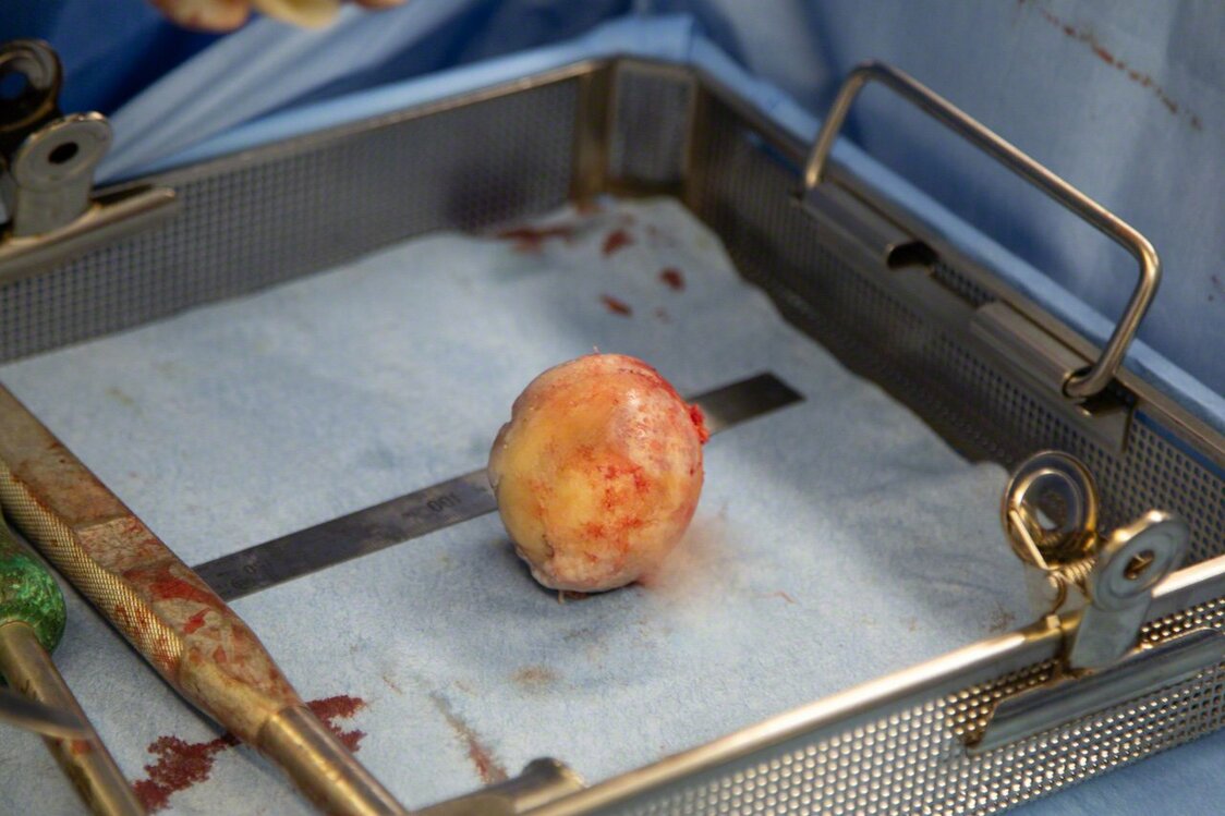 取り出された大腿骨頭。本来、軟骨は真珠のような色をしていて、変性すると黄色みが増す。妻の場合は軟骨がすり減り、その下の骨まで出ていたという。「骨は神経がありますからね、歩くと痛かったでしょうね」と松原医師