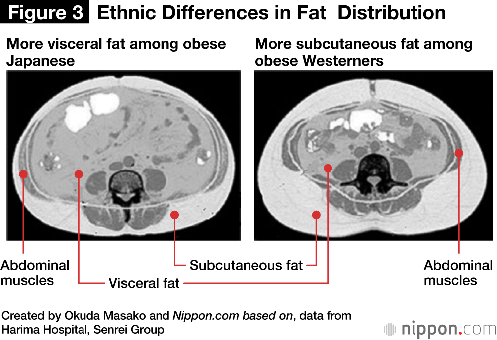 Cross-sections showing the distribution of abdominal fat in representative Japanese (left) and Westerners (right)  subjects.