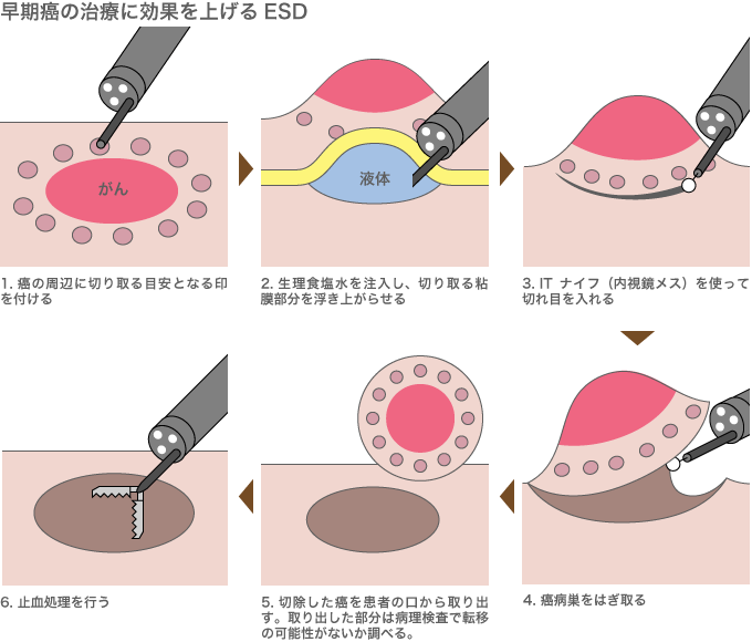 ESDは、内視鏡によって行われる最新の手術技法。以前のEMRと呼ばれる手技では投げ縄状の処置具で腫瘍をつまんで切除していたため、切除できる腫瘍の大きさが限られていた。ESDでは、内視鏡メス（ナイフ）を使って切除することで、2ｃｍ以上の腫瘍にも対応できる。日本では、すでに胃癌患者の4人に1人がこのESDによる治療を受けられるという。 参考文献：『ガンを切らずに治す内視鏡治療「ESD」がわかる本』講談社