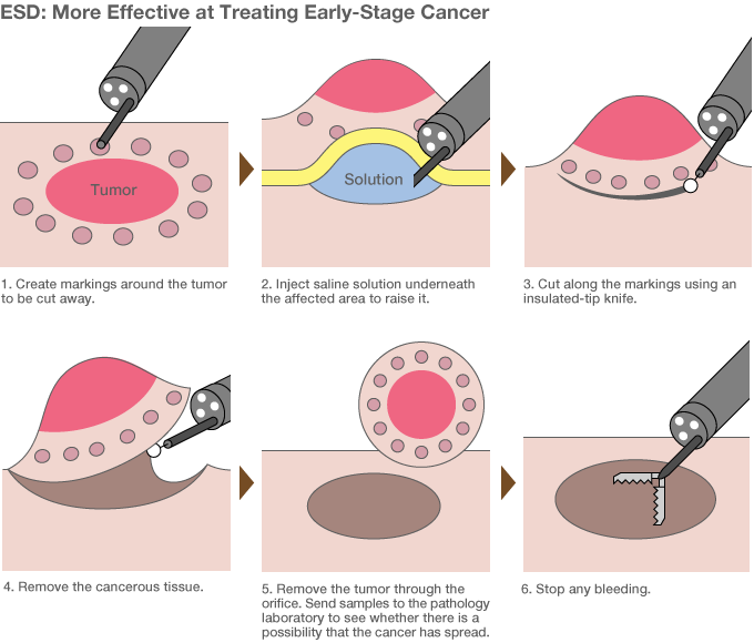 ESD is the latest method of surgery performed with endoscopes. Previously, EMR (endoscopic mucosal resection) procedures used a lasso-shaped tool to cut away tumors, but could only deal with growths below a certain size. By using a small scalpel, doctors can use ESD to excise tumors larger than 2 centimeters. In Japan, around one in four stomach cancer patients are already receiving this treatment. Source: “Gan o kirazu ni naosu naishikyō chiryō ESD ga wakaru hon” (Understanding ESDs: A Procedure for Treating Cancer Without Major Surgery) (Kōdansha, 2011).