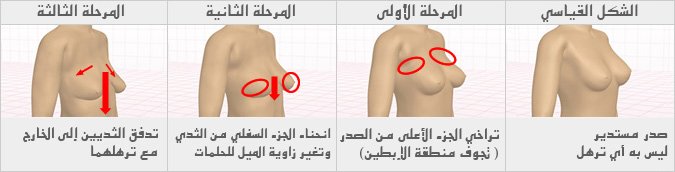 [تغير شكل الصدر مع التقدم في العمر] يبدأ ارتخاء الصدر من بداية العشرينات من العمر. ولكن في نفس الوقت يوجد بعض النساء يدخلن ضمن المرحلة الثانية.