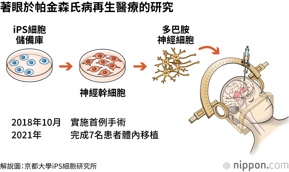 著眼於帕金森氏病再生醫療的研究