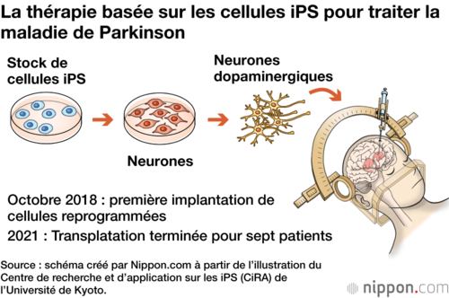 La thérapie basée sur les cellules iPS pour traiter la maladie de Parkinson
