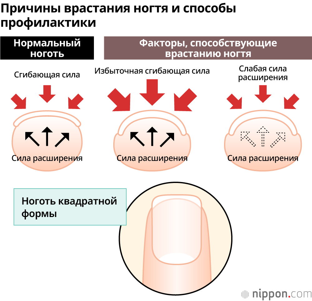 Причины врастания ногтя и способы профилактики