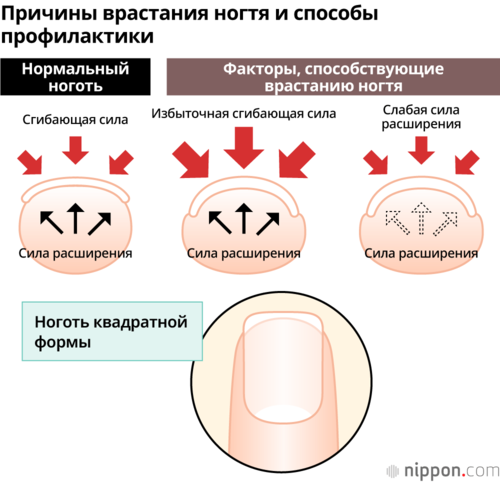 Причины врастания ногтя и способы профилактики