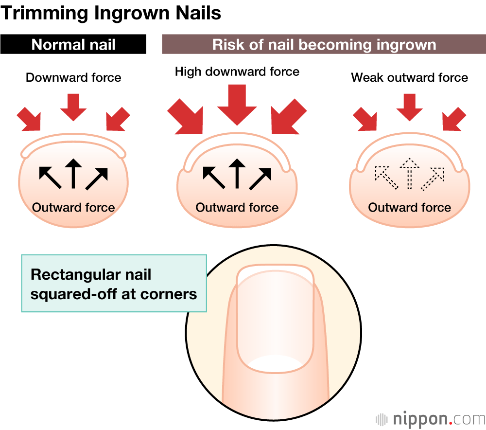 Trimming Ingrown Nails