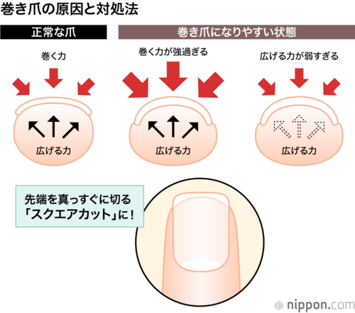 巻き爪の原因と対処法