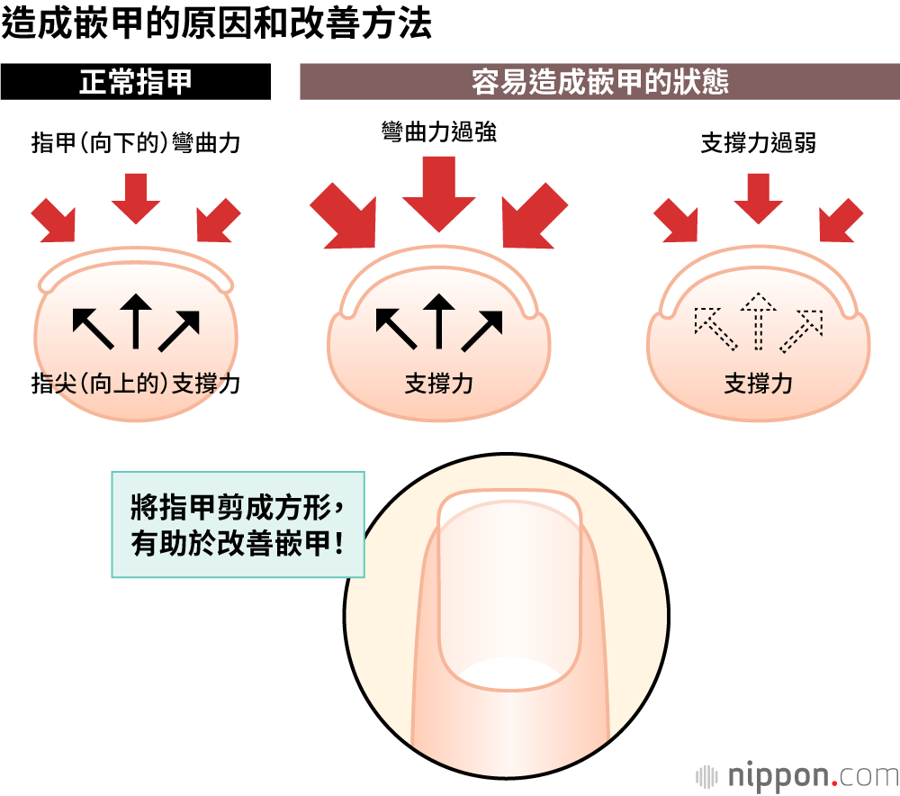 造成嵌甲的原因和改善方法