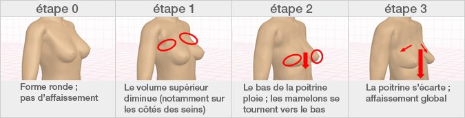 Modification de la poitrine avec l’âge. Au-delà de la vingtaine, la poitrine commence à s’affaisser, certaines femmes peuvent se trouver à l’étape 2 déjà avant 30ans.