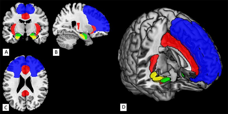 Changes in the brain induced by an eight-week meditation program, such as MBSR. A. coronal section; B. sagittal section; C. transverse section; D. composite view. Blue indicates the prefrontal cortex, associated with the immune system and resilience. Yellow indicates the hippocampus, associated with memory. The upper red region is the cingulate cortex, associated with emotional and impulse control and dealing with conflict. The lateral red regions are the insulae, which integrate bodily sensations and process internal sensations. The green indicates the amygdala, which governs emotions and regulates stress hormone secretion. Meditation training was shown to increase activity in the blue, yellow, and red regions and reduce activity in the green. Source: R. A. Gotink et al, “8-week mindfulness based stress reduction induces brain changes similar to traditional long-term meditation practice–a systematic review.” Brain and Cognition, 108 (2016), 32–41.