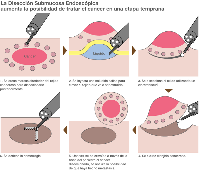 La Disección Submucosa Endoscópica es una nueva técnica que se realiza con la ayuda del endoscopio. En la antigua técnica de la Resección Mucosa Endoscópica se utilizaba un instrumento con el que se rodeaba con un lazo el tumor para después cortarlo, pero esta técnica estaba limitada por el tamaño del tumor. En cambio, con la Disección Submucosa Endoscópica se pueden cortar tumores de más de dos centímetros utilizando el bisturí endoscópico. En Japón, uno de cada cuatro pacientes con cáncer de estómago es ya intervenido con una Disección Submucosa Endoscópica. Fuente: Gan o kirazu ni naosu naishikyō chiryō ESD ga wakaru hon (Cómo tratar el cáncer sin diseccionarlo a través de la endoscopia, Kodansha).