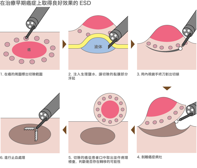 內視鏡黏膜剝離術（ESD），是最新的內視鏡治療術。以前的內視鏡黏膜切除（EMR）治療術，是用套索狀的器具夾住腫瘤後予以切除，所以可切除的腫瘤大小有限。ESD是用內視鏡手術刀切除，所以對付2cm以上的腫瘤也游刃有餘。據說在日本胃癌患者的四分之一接受的都是這種ESD治療。參考文獻：《不開刀切癌症：詳解ESD內視鏡治療術》，講談社