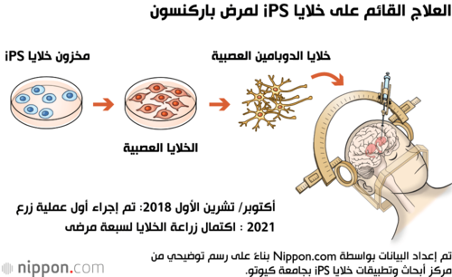 العلاج القائم على خلايا iPS لمرض باركنسون