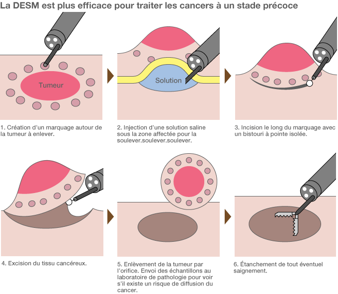 La DESM est la plus récente méthode d’intervention chirurgicale à l’aide d’un endoscope. Auparavant, la résection mucosale endoscopique (RME), qui utilisait un instrument en forme de lasso pour exciser les tumeurs, ne permettait pas d’intervenir au-dessus d’une certaine taille. En se servant d’un petit scalpel, les praticiens peuvent appliquer la DESM pour enlever des tumeurs de plus de deux centimètres de diamètre. Au Japon, environ un patient sur quatre affectés du cancer de l’estomac bénéficie d’ores et déjà de ce traitement. Source : « Gan o kirazu ni naosu naishikyô chiryô ESD wakaru hon » (Comprendre la DESM : une méthode de traitement du cancer sans chirurgie lourde) (Kôdansha, 2011)